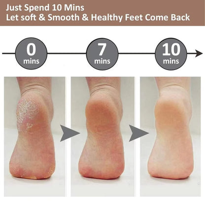 CalluEase Electric Foot Remover