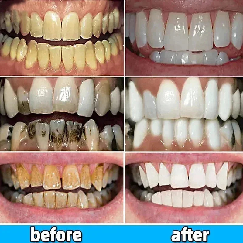 Dental Calculus Remover Toothpaste for Whitening