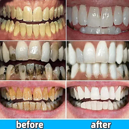 Dental Calculus Remover Toothpaste for Whitening