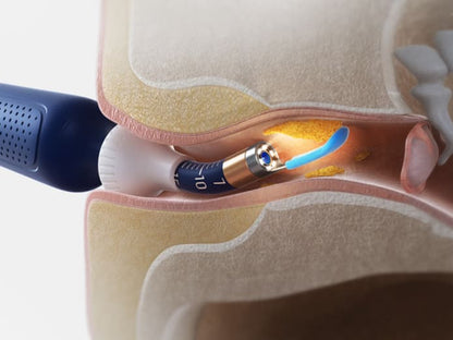 Visual Ear Wax Remover